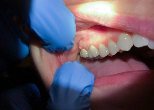 Best Emergency Treatment for Dental Infections or Abscesses in Spearfish, SD